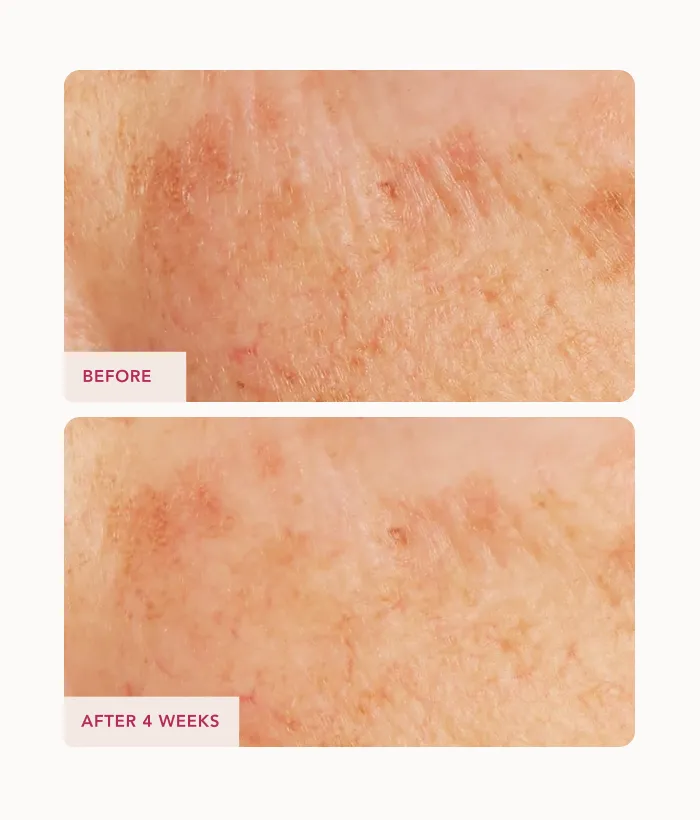 Lancer Caviar Lime Acid Peel Gesichtsmaske 10% AHA